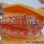 anti snoring devise