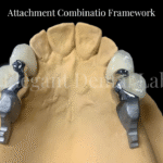 attachment combination framework