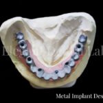 metalimplantdesign
