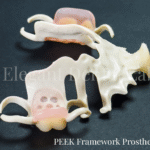 peek framework prosthesis
