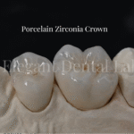 porcelain zironia crwon
