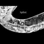 splint