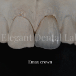 emax crwon