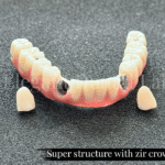 super structure with zir crowns