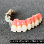 super structure with zir crowns 3